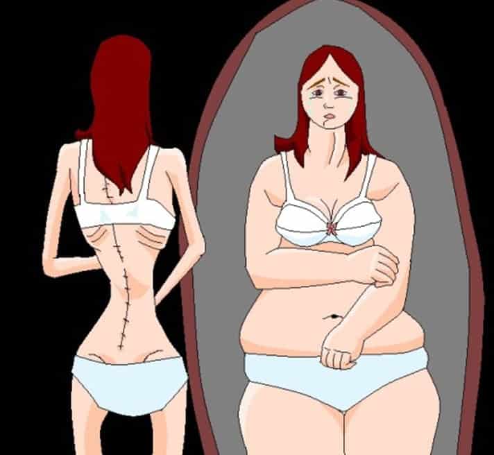  10 bago at pagkatapos ng mga taong nagtagumpay sa anorexia - Mga Lihim ng Mundo